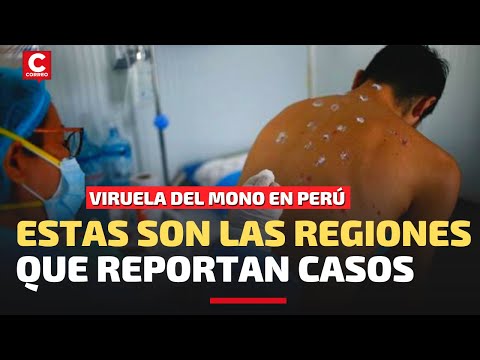 VIRUELA DEL MONO EN PERÚ: 1937 casos y la enfermedad se reporta en 18 regiones