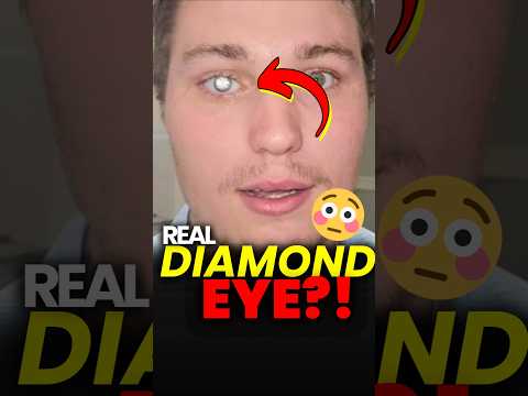 Diamond Eye?! 😱 Alabama Man Turns Loss into Sparkle 💫
