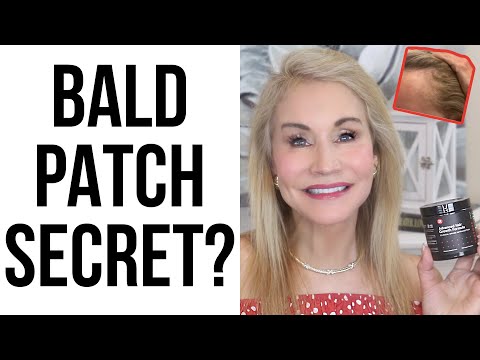 BALD PATCHES? DOES ANYTHING WORK? GREAT STUDY!