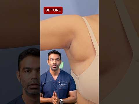 What is Axillary Breast Tissue?