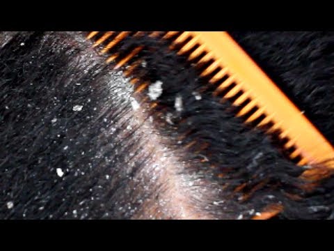 Satisfying Dandruff Removal | HUGE FLAKES !!!