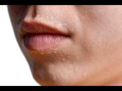 ¿Qué es la hiperhidrosis craneofacial? Doctor explica por qué las personas sudan mucho