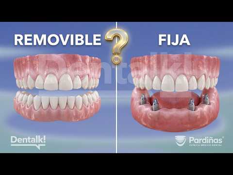 Prótesis completas removibles o dentaduras fijas - ¿Cuál es la mejor opción para ti?