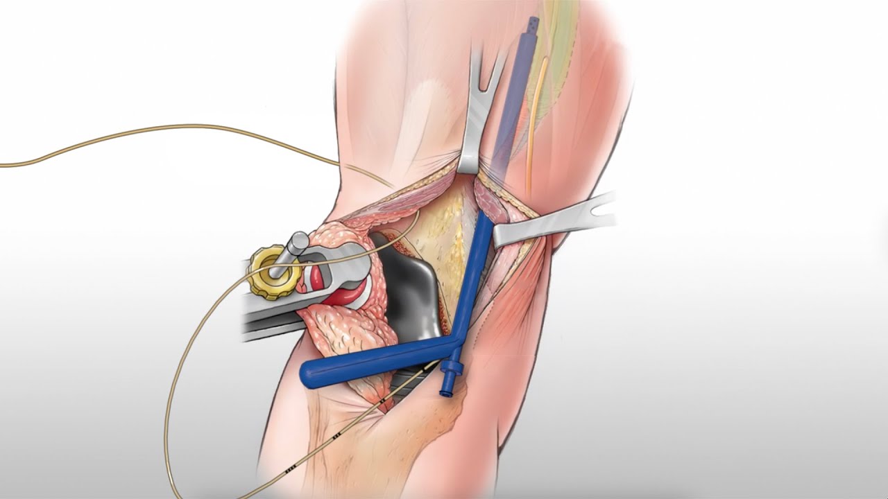 Opioid-Free Knee Surgery / Surgeon-Placed Adductor Canal Block