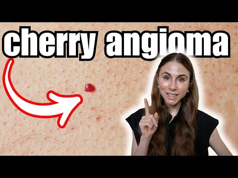 Cherry Angiomas: Causes, Removal, and Diagnosis Tips