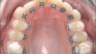 Лечение на невидимых (лингвальных) брекетах STB с удалением одного зуба
