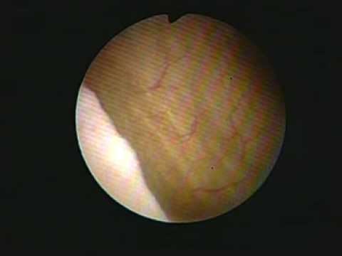 Cystoscopy - YouTube