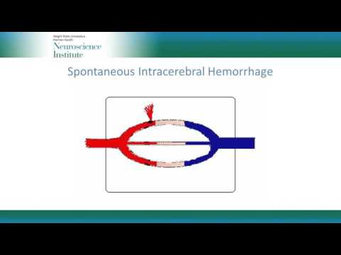 Management Principles for Spontaneous Intracerebral Hemorrhage