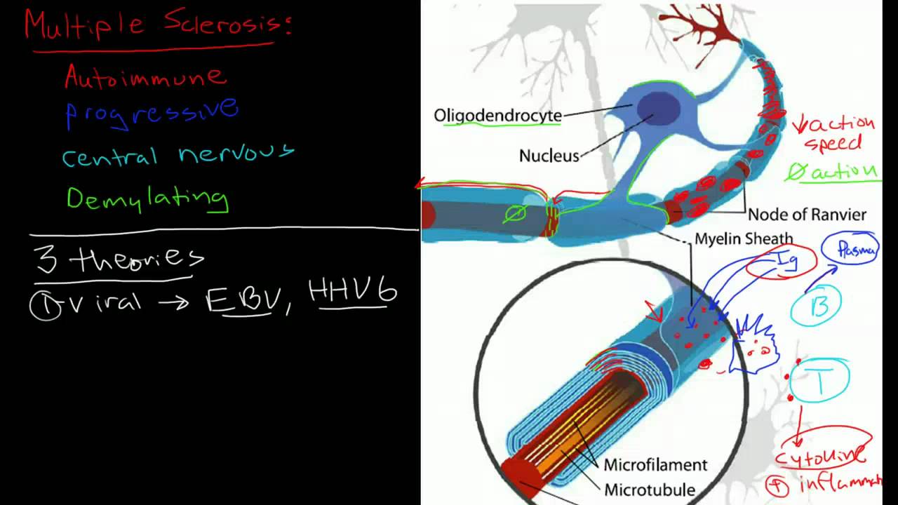 Pathophysiology of multiple sclerosis youtube