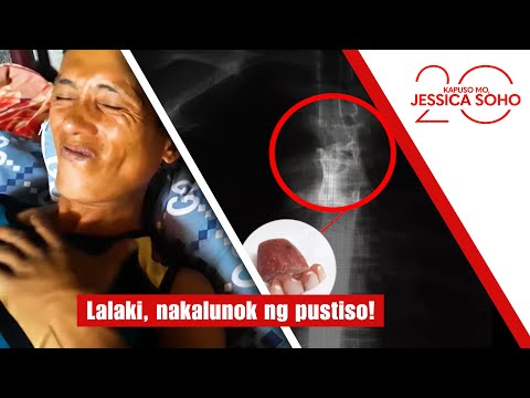 Lalaki, nakalunok ng pustiso! | Kapuso Mo, Jessica Soho