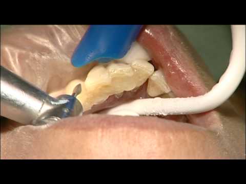 EverStickPERIO PERIODONTAL SPLINTING YouTube