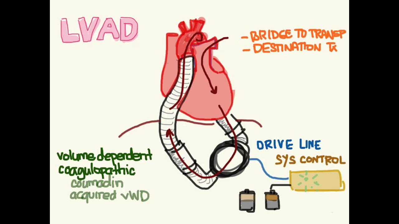 lvad-01-anatomy-and-physiology-youtube