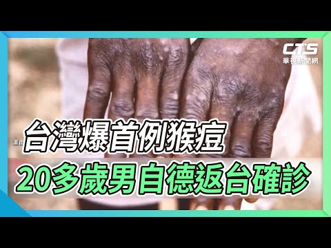 台灣爆首例猴痘 20多歲男自德返台確診｜華視新聞 20220624