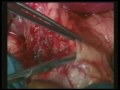 Gallbladder Cancer Resection - Subhepatic Dissection