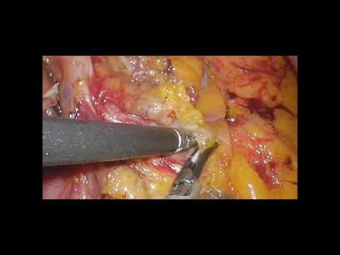 Laparoscopic Bile Duct Resection with Lymph Node Dissection for Postoperatively Diagnosed Gallbladder Cancer