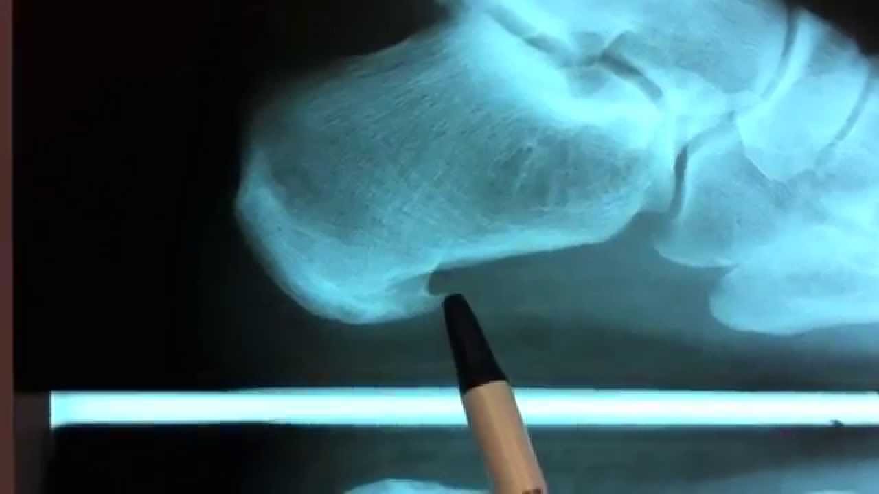 Heel Spur / Plantar Fasciitis Surgery Houston Foot Surgeon Dr