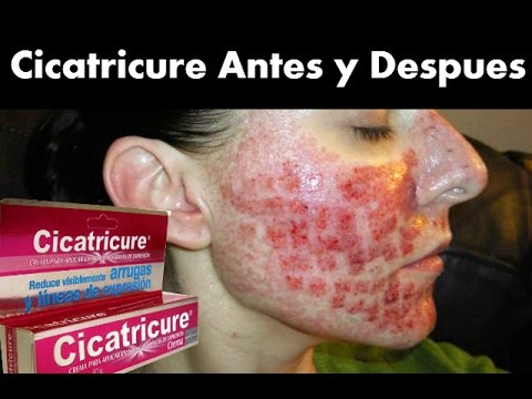 Estrias cicatricure antes y despues de adelgazar Estrias cicatricure antes y despues de adelgazar