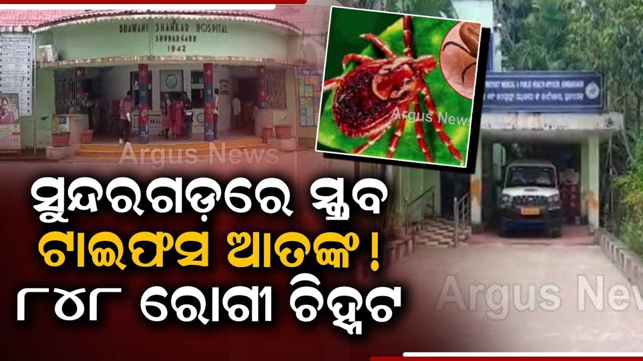 Scrub Typhus Cases Surge In Sundargarh: 848 Tested Positive, Health Teams On Alert | Argus News