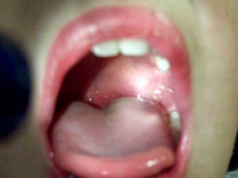 Phlegm Stuck In Throat 35