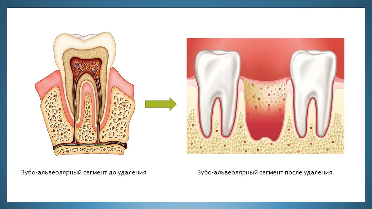 Удаление зуба схема