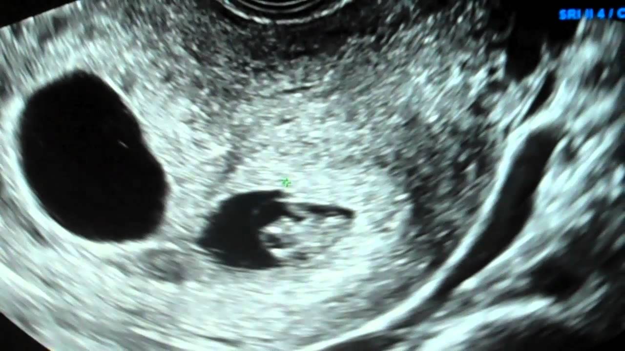 8 Week Ultrasound TWINS With Heartbeats IVF YouTube