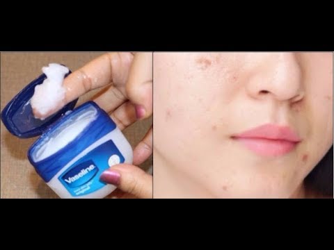 कैसे Vaseline से 3 दिन में चेहरे से दाग धब्बे, मुँहासे के निशान, झाइयों को गायब करें |Vaseline Hacks