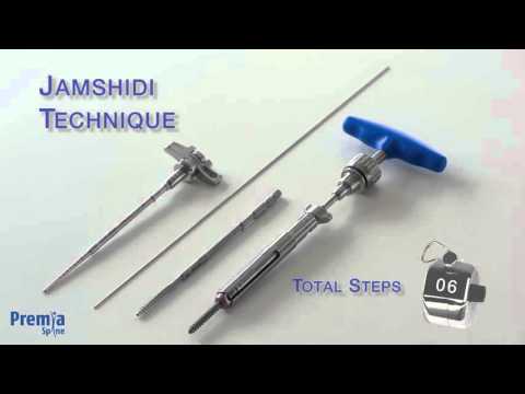 ProMIS Fixation System v8 04 04 2016 HD ProMIS Fixation System v8 04 04 2016 HD