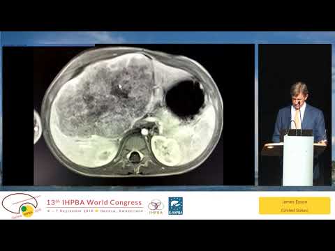 SS03.4 IHPBA Meets ILTS: Can Liver Transplantation Cure Liver Cancer?