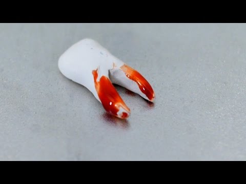 TOOTH YANKED OUT!
