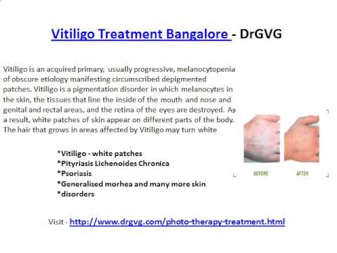 Vitiligo Treatment Bangalore - DrGVG