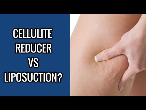 How to get rid of cellulite with a cellulite reducer or liposuction ...