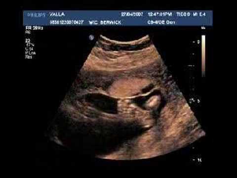 BABY ULTRASOUND ITS A GIRL! 22 WEEKS - YouTube