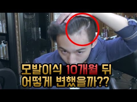 모발이식 10개월차 리뷰