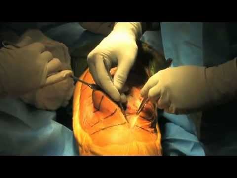 Total Knee Replacement Surgery 2011 - HD - YouTube diagram of knee replacement 