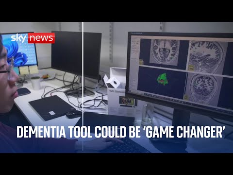 New AI tool hailed as a 'game-changer' for Alzheimer's