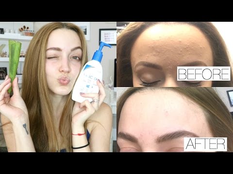 Skin Update | Chit Chat + What I've Been Using to Help My Skin