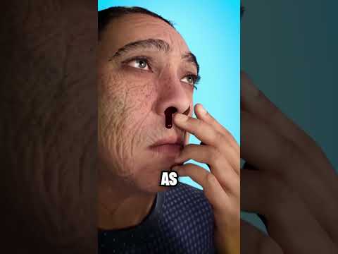 How To Stop A Bloody Nose! 😱