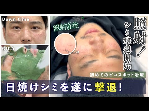 【肌改善】遂に…シミ撃退！王 蘇医師のピコスピットに密着！【レーザー治療】王医師の肌改善の旅03 #肌質改善 #美容皮膚科 #ピコスポット