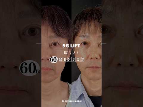 【5Gリフト】男性でも若返り!自然な仕上がりに感動✨4〜5年持続の糸リフト