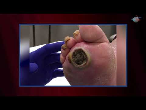 WCW: Debriding a Plantar Ulcer to Prevent Infection