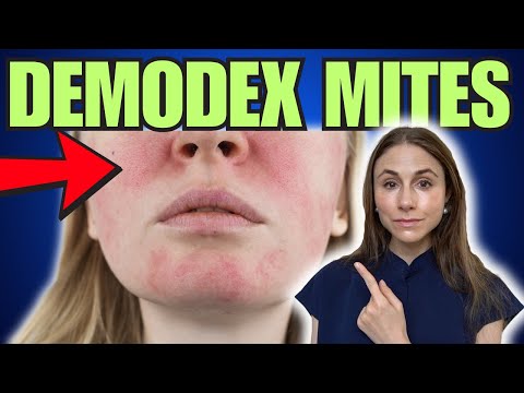 Combat Demodex Mites: Skincare Solutions for Rosacea
