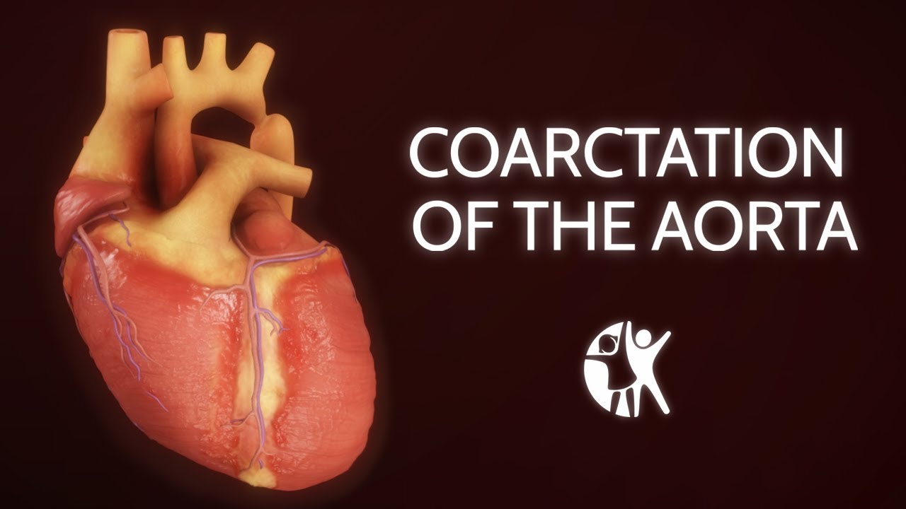 Coarctation of the Aorta - YouTube