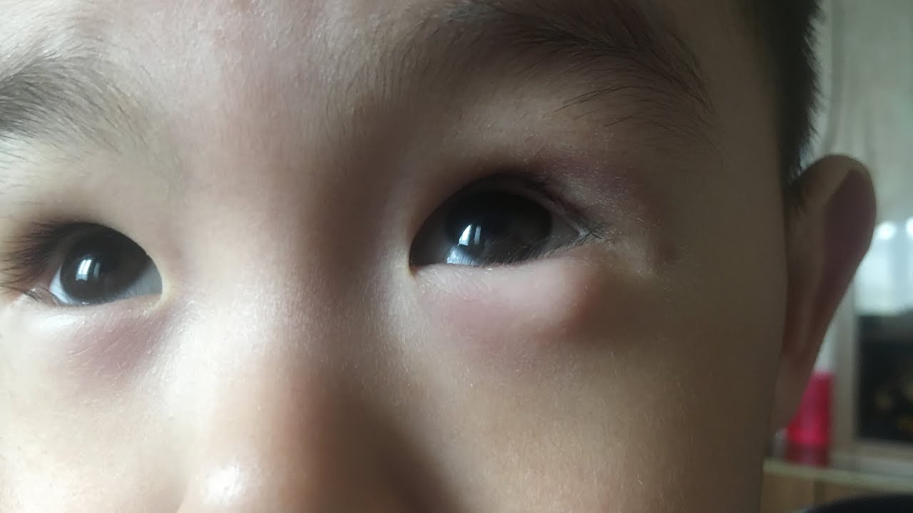Как начинается ячмень на глазу у ребенка фото