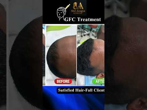 GFC treatment for Hairfall control... #gfc #prp #hairfall #hairloss #dermatologist #kannada #laser