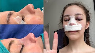 why my 2 nose jobs weren't worth it *part 1* (MY EXPERIENCE, PHOTOS, VLOG)