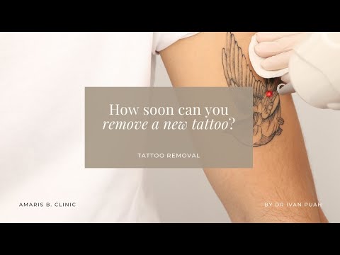 How soon can you remove a new tattoo? | Amaris B. Clinic by Dr Ivan Puah