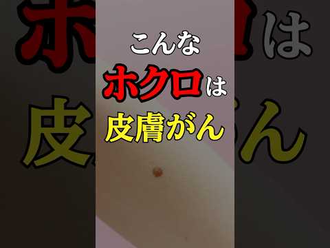 こんな「ほくろ」は絶対見逃さないで#医師#皮膚がん#予防医学チャンネル