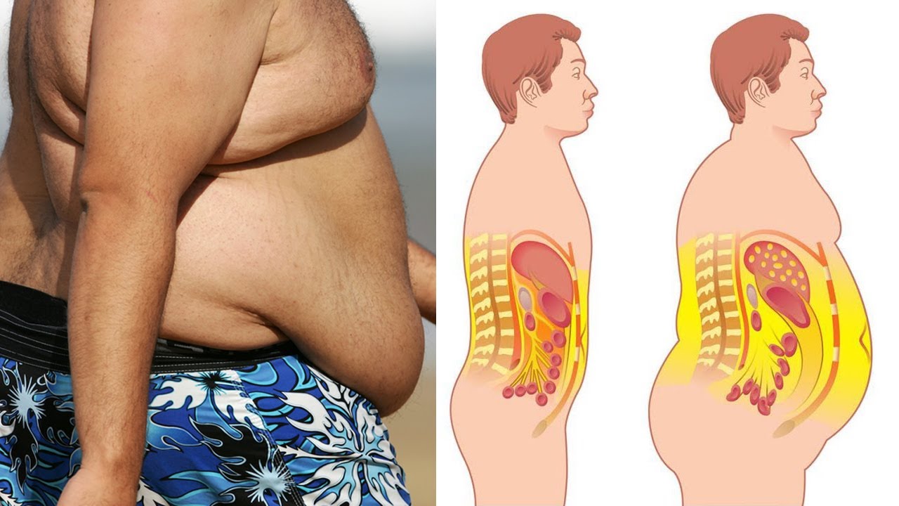 Кортизоловое ожирение у женщин фото