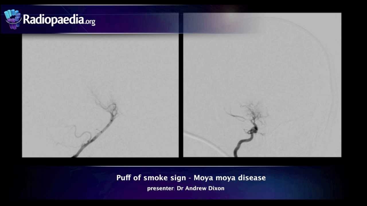 Puff of smoke sign radiology video tutorial angiography youtube