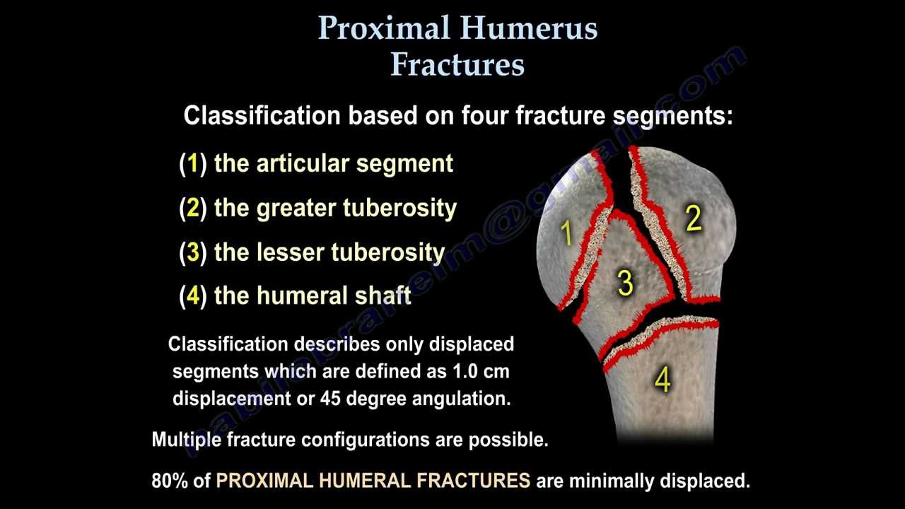 Proximal Humerus Fractures Classification Everything You Need To Know